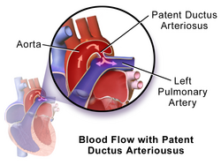 Initial direction of blood flow in patients with patent ductus arteriosus. Once the pressure of the pulmonary arteries increases more than the aorta due to right heart hypertrophy, the direction of blood flow reverses, sending deoxygenated blood through the patent duct directly into the descending aorta while sparing the brachiocephalic trunk, left common carotid, and left subclavian artery, therefore causing the differential cyanosis.