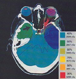 Treatment plan for an Optic nerve sheath meningioma