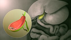 3D still, showing gallstones