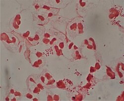 Neisseria gonorrhoeae and pus cells from a penile discharge (Gram stain)