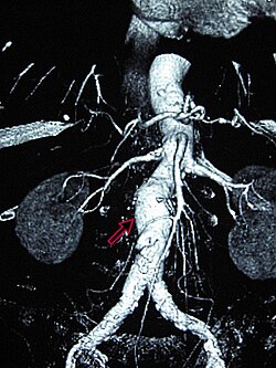 Abdominal aortic aneurysm