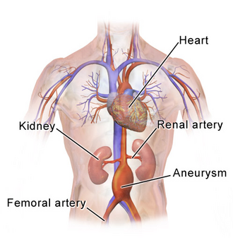 Abdominal aortic aneurysm location