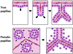 Papillae vs pseudopapillae: True papillae are outgrowths of epithelium, surrounding fibrovascular cores of stroma and at least one blood vessel. In contrast, pseudopapillae (such as in solid pseudopapillary tumours) are nests of proliferating cells that eventually grow to become almost back-to-back, with cells in the centers of nests disintegrating, leaving rims of cells lining the periphery of each nest. Discohesive cells and some formations lacking central blood vessels are visual clues.
