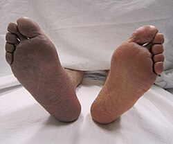 Cyanosis of the right lower limb due to arterial thrombosis (on the left side of the picture).