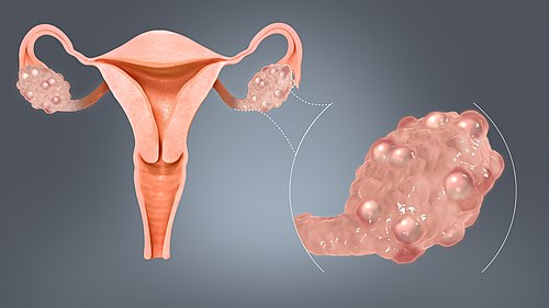 Polycystic ovaries typically found in polyendocrine metabolic ovarian syndrome