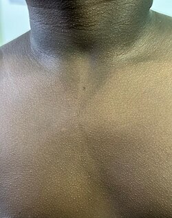 Scarlet fever rash in dark skin