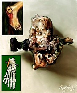 1st century calcaneum (heel bone) with a nail