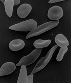 Affected by Sickle-cell disease, red blood cells alter shape and threaten to damage internal organs.