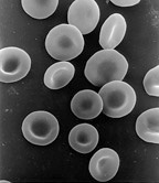 Human red blood cells, like those of other mammals, lack nuclei. This occurs as a normal part of the cells' development.