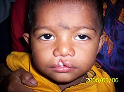 A child with cleft lip
