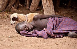 An Ethiopian child with malaria, a disease with an annual death rate of 619,000 as of 2021.[16]