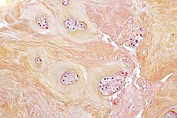 Micrograph showing a fragment of an intervertebral disc demonstrating degenerative fibrocartilage with loss of nuclei and nests of chondrocytes, as seen in degenerative disc disease. HPS stain.