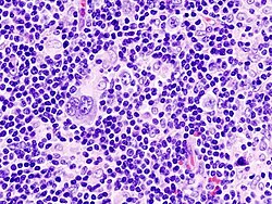 Lymph node biopsy showing Hodgkin lymphoma, mixed-cellularity type