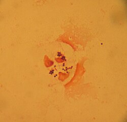 Typical gram-positive cocci, in clusters, from a sputum sample, Gram stain