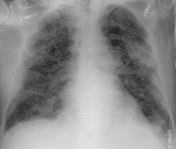 Chest X-ray showing COVID‑19 pneumonia