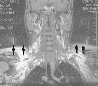 Motion artifact (T1 coronal study of cervical vertebrae)[149]