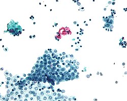 Micrograph of benign mesothelial cells. Peritoneal wash. Pap stain.