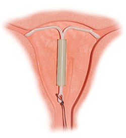Intrauterine coil