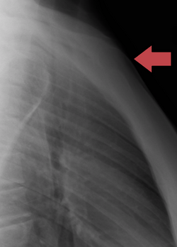 Manubrium sternal dislocation