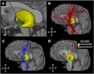 The subthalamic nucleus, immediately above the substantia nigra and below the thalamus, is the most common target for treatment in Parkinson's