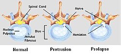 Stages of spinal disc herniation