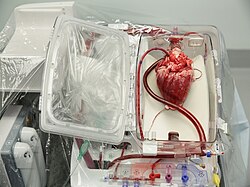 A beating heart awaiting transplant