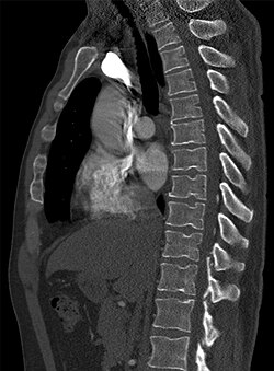 Notochord regression anomaly: linear pattern of indentations in vertebral discs.