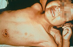 A child bitten by a flea infected with the bacterium Yersinia pestis. Y. pestis, a member of the family Yersiniaceae, has caused the bite to become ulcerated.
