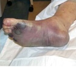 Septicemic plague resulting in necrosis