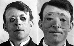 Walter Yeo, a sailor injured at the Battle of Jutland, is assumed to have received plastic surgery in 1917. The photograph shows him immediately following (right) the flap surgery by Sir Harold Gillies, and after healing (left).[citation needed]