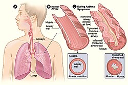 Figure A shows the location of the lungs and airways in the body. Figure B shows a cross-section of a normal airway. Figure C shows a cross-section of an airway during asthma symptoms.