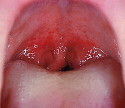 Streptococcal pharyngitis with red throat/uvula and spots on roof of mouth