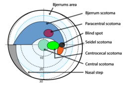 Bjerrum's area and types of scotomas on the visual field