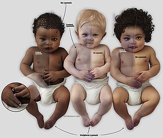 Presentation of cyanosis varies depending on the color of the skin