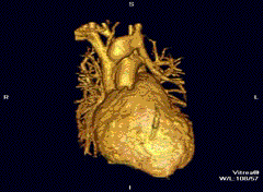 MR angiogram in congenital heart disease