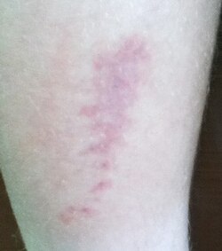 Buck moth caterpillar sting on a shin twenty-four hours after occurrence in south Louisiana. The reddish mark covers an area about 20 mm (0.79 in) at its widest point by about 70 mm (2.8 in) in length.