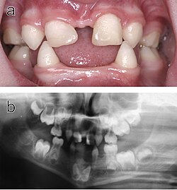 Dental abnormalities in a five-year-old girl from northern Sweden who suffered from various symptoms of autosomal dominant hypohidrotic ectodermal dysplasia (HED) a) Intraoral view. Note that the upper incisors have been restored with composite material to disguise their original conical shape. b) Orthopantomogram showing absence of ten primary and eleven permanent teeth in the jaws of the same individual.