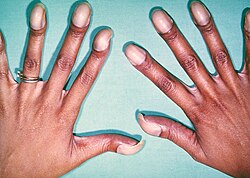 An example of cyanosis in an individual with darker skin pigmentation. Note the pale purple (instead of the typical bluish-purple hue) nail beds. This patient also had prominent digital clubbing due to a congenital heart disease with right-to-left shunting (this patient had Tetralogy of Fallot).