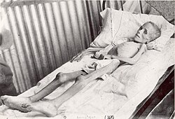 Boer child in a British concentration camp during the Second Boer War (1899–1902)