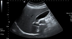 Abdominal ultrasonography showing gallbladder and common bile duct