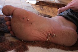 Caltrop, Tribulus terrestris, is sometimes considered a pest plant because of its sharp spiny burrs, shown here in a person's foot.[11]