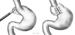 Nissen fundoplication