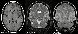 Examples of T1-weighted, T2-weighted and PD-weighted MRI scans