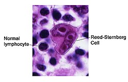 Micrograph of a classic Reed–Sternberg cell