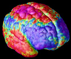 Map of deficits in neural tissue throughout the human brain in a patient with schizophrenia. The most deficient areas are magenta, while the least deficient areas are blue.