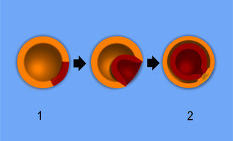 Gastrulation of a diploblast: The formation of germ layers from a (1) blastula to a (2) gastrula. Some of the ectoderm cells (orange) move inward forming the endoderm (red).