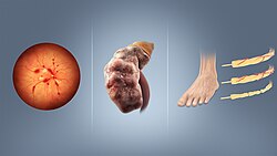 Retinopathy, nephropathy, and neuropathy are potential complications of diabetes