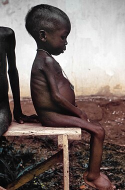 A child with kwashiorkor during the Nigerian Civil War
