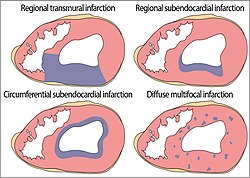 Topographic distribution of MI