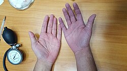 This illustration depicts a self-induced local (tissue) hypoxia on the right hand (right side of the picture) versus a normal left hand (left side of the picture). The cyanosis was achieved by inflating and tightening the blood pressure cuff on the right arm.